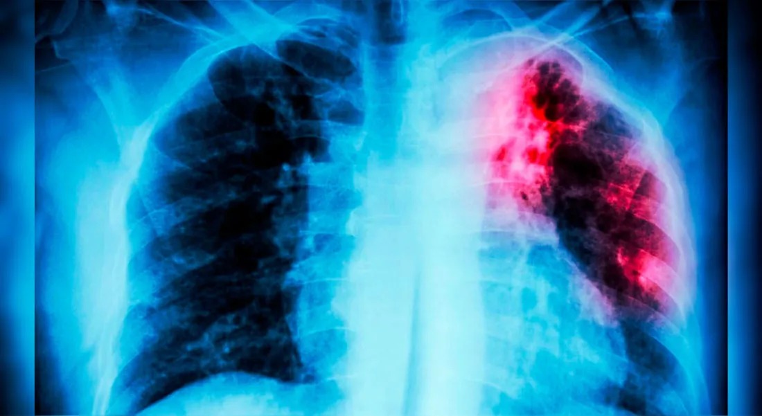 Antioquia, el primer departamento en implementar pruebas vanguardistas para el diagnóstico rápido de tuberculosis