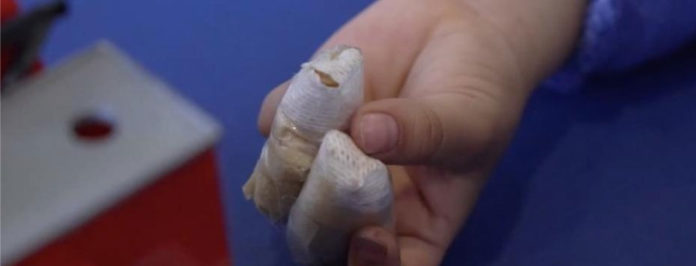 WEB-Antioquia-suma-el-segundo-caso-de-amputación-por-pólvora,-un-menor-de-14-años-en-Medellín.-Ya-son-29-quemados